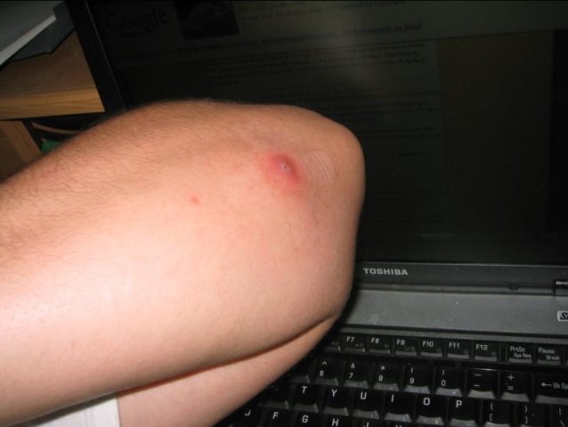 Where can one find photographs of spider bites?