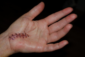carpal-tunnel-surgery-photo-by-daveparker.jpg