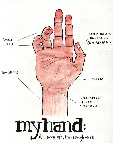 carpal tunnel symptoms. to carpal tunnel syndrome