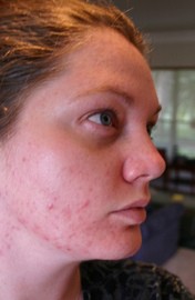 acne-by-calliope1.jpg