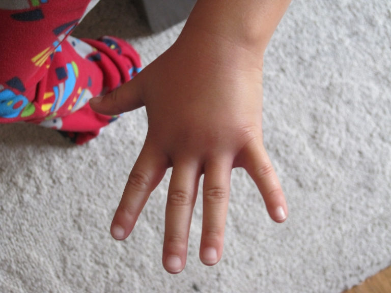 Symptoms Of An Allergic Reaction To A Bee Sting Or Insect Bite See