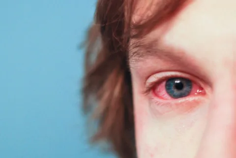allergy red eye