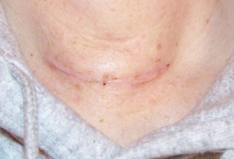 thyroid surgery recovery photos - thyroid scars