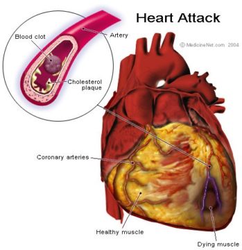 Heart Trouble: How To Recognize A Heart Attack or Stroke | Healthy ...