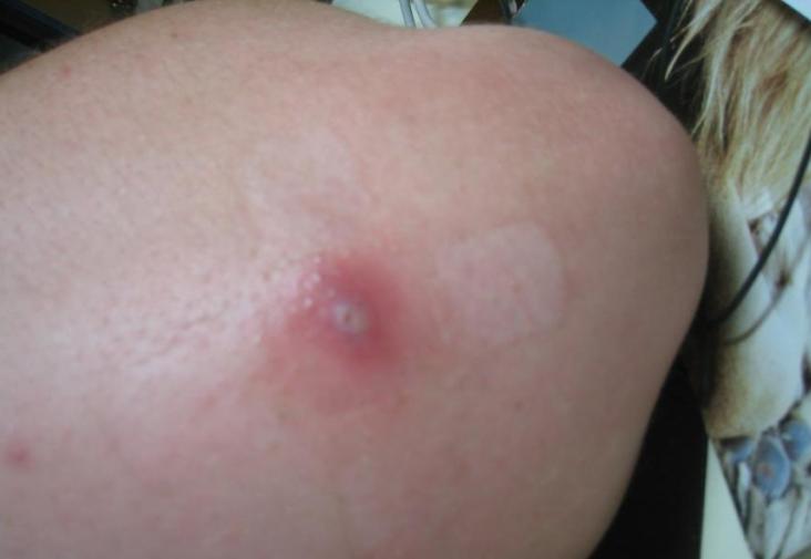 Pictures Of Bites Of A Brown Recluse 100