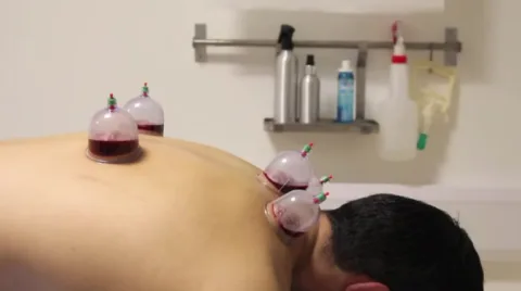 cupping therapy cups