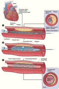 here is a diagram that documents the stages of the stent procedure