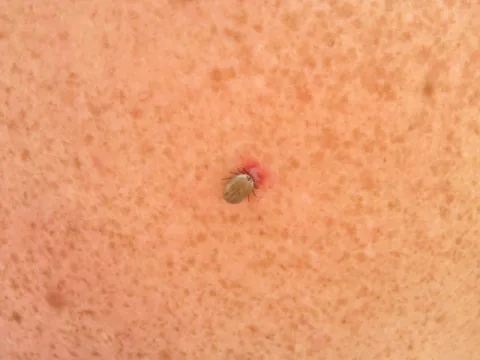 This is an engorged tick biting on human skin.