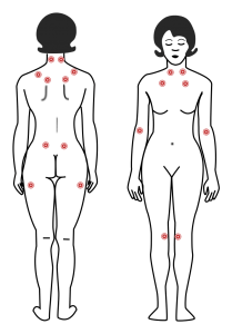 fibromyalgia-tender-points