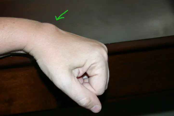 What are the possible causes of a lump in the hand?