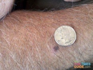 you can see that the mole has grown - this is 1.5 years before his melanoma diagnosis