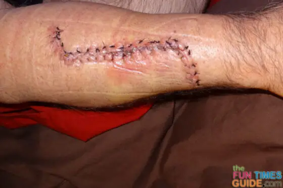 melanoma-cancer-incision-5-days-after-surgery