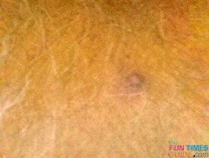 melanoma skin cancer 6 months before his biopsy and melanoma diagnosis