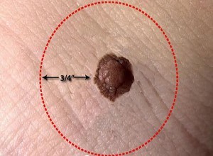 A mole that turned out to be melanoma skin cancer