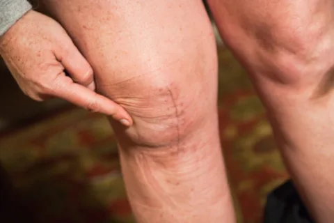 photo-after-knee-replacement-surgery