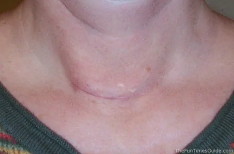 thyroid scar photo - 1 month post thyroid surgery photo