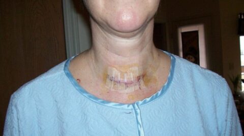 thyroid surgery recovery - thyroid scars