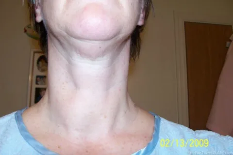 thyroid surgery was a must for me because I had a non-cancerous nodule (visible here)