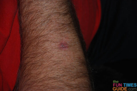 melanoma skin cancer arm 25 days after biopsy