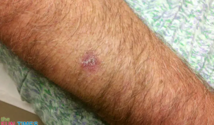 scar-from-punch-skin-biopsy