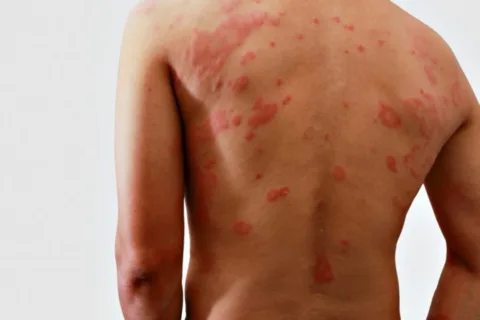 shingles symptoms can appear like a large splotchy rash - but there are home remedies for shingles that help