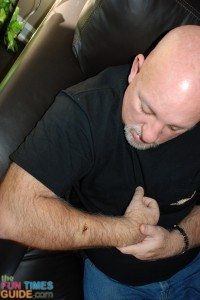 jim skin cancer photos - this was right after the mole was biopsied by the dermatologist