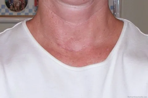 3 months post thyroid surgery recovery - thyroid scar photos