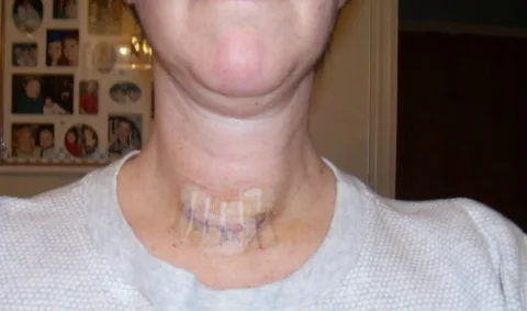 thyroid surgery photos - thyroid scar photo 5 days post operation