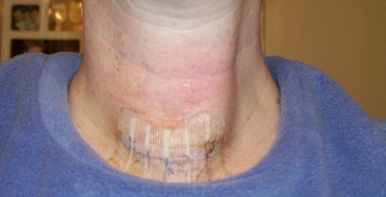 What can you expect after neck surgery?