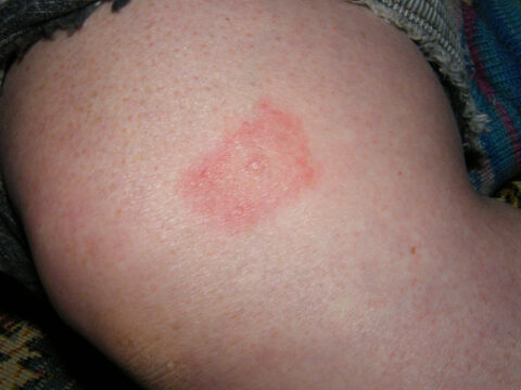 red rash or Lyme Disease rash that often occurs after being bitten by an infected tick 