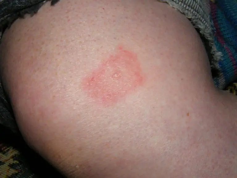 I'm Living With Lyme Disease In Tennessee - I Got The Lyme Disease Rash ...